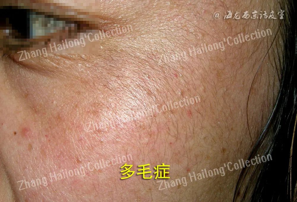 猕猴桃女孩冰点脱毛频率,激光脱毛猕猴桃女孩必备