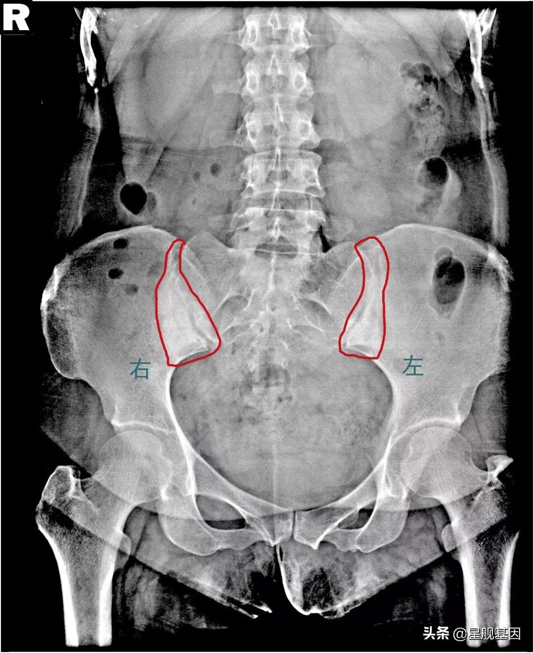 产后咳嗽腰疼痛是什么原因,产后腰痛睡觉躺着痛怎么回事