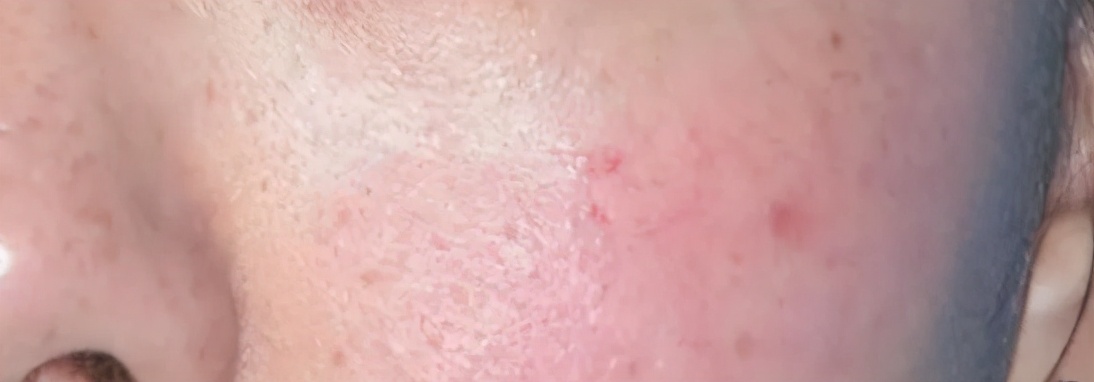 如何根据不同肤质挑选护肤品呢,角质层薄混合肤质用什么护肤品