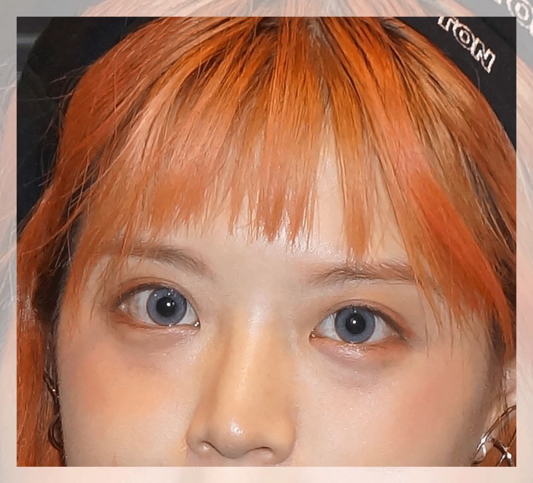 一次就能让黑眼圈消失的办法,一针下去瞬间没了黑眼圈