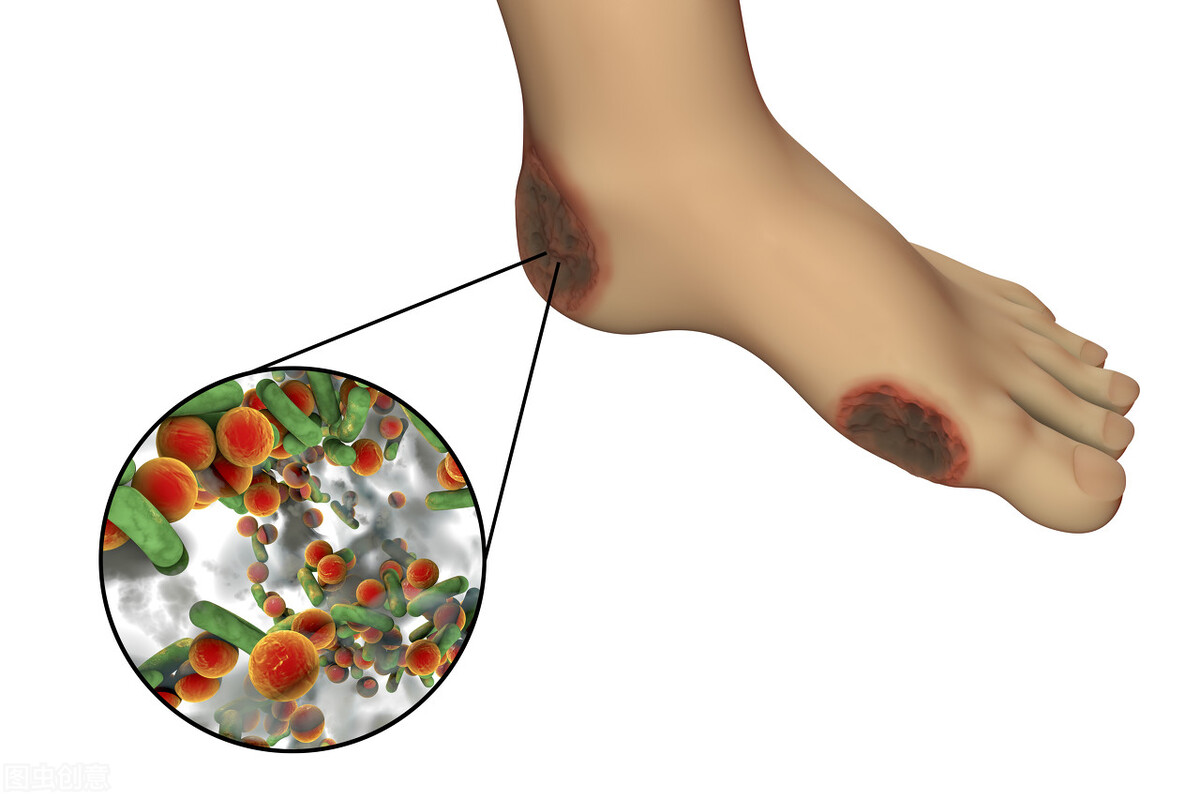 糖尿病为什么会出现糖尿病足呢,糖尿病怎么不出现糖尿病足