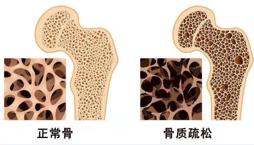 健康科普骨质疏松症,骨质疏松日科普宣传