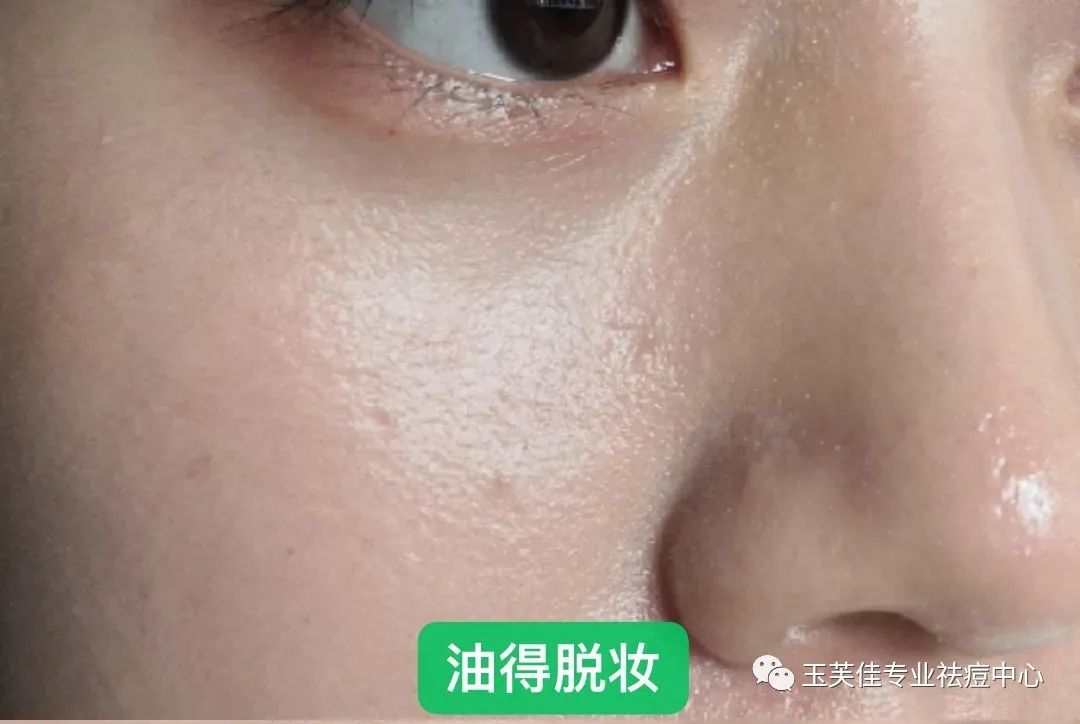 痘痘肌化妆教程用什么颜色遮瑕,痘痘肌化妆教程初学者淡妆