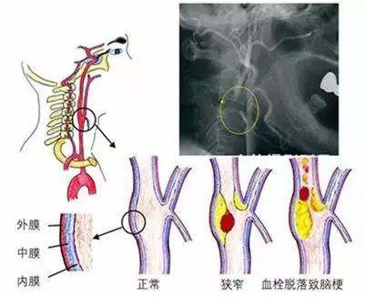 体检出现颈动脉斑块怎么治疗,体检颈动脉斑块形成是怎么回事