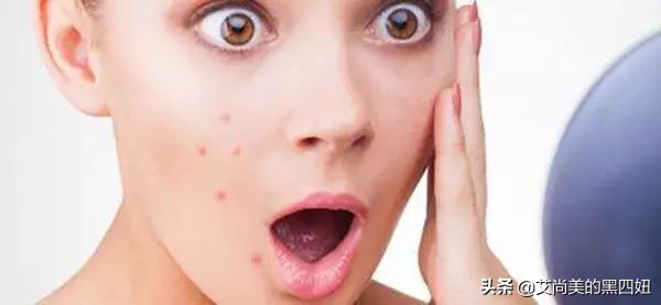 嘴巴周围老是反复长痘已经半年了,47岁嘴周围反复长痘什么原因