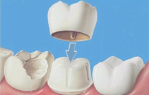 全瓷牙和烤瓷牙的区别到底在哪,全瓷牙与普通烤瓷牙的区别是什么