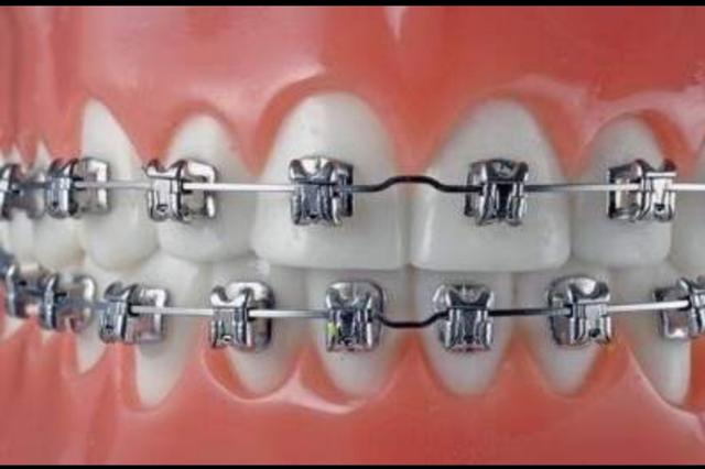 正畸初诊治疗需要验血吗,正畸初诊到戴牙套多久