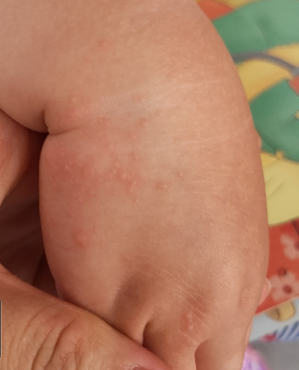 带孩子去海边需要注意什么,孩子去海边玩身上起红疹子