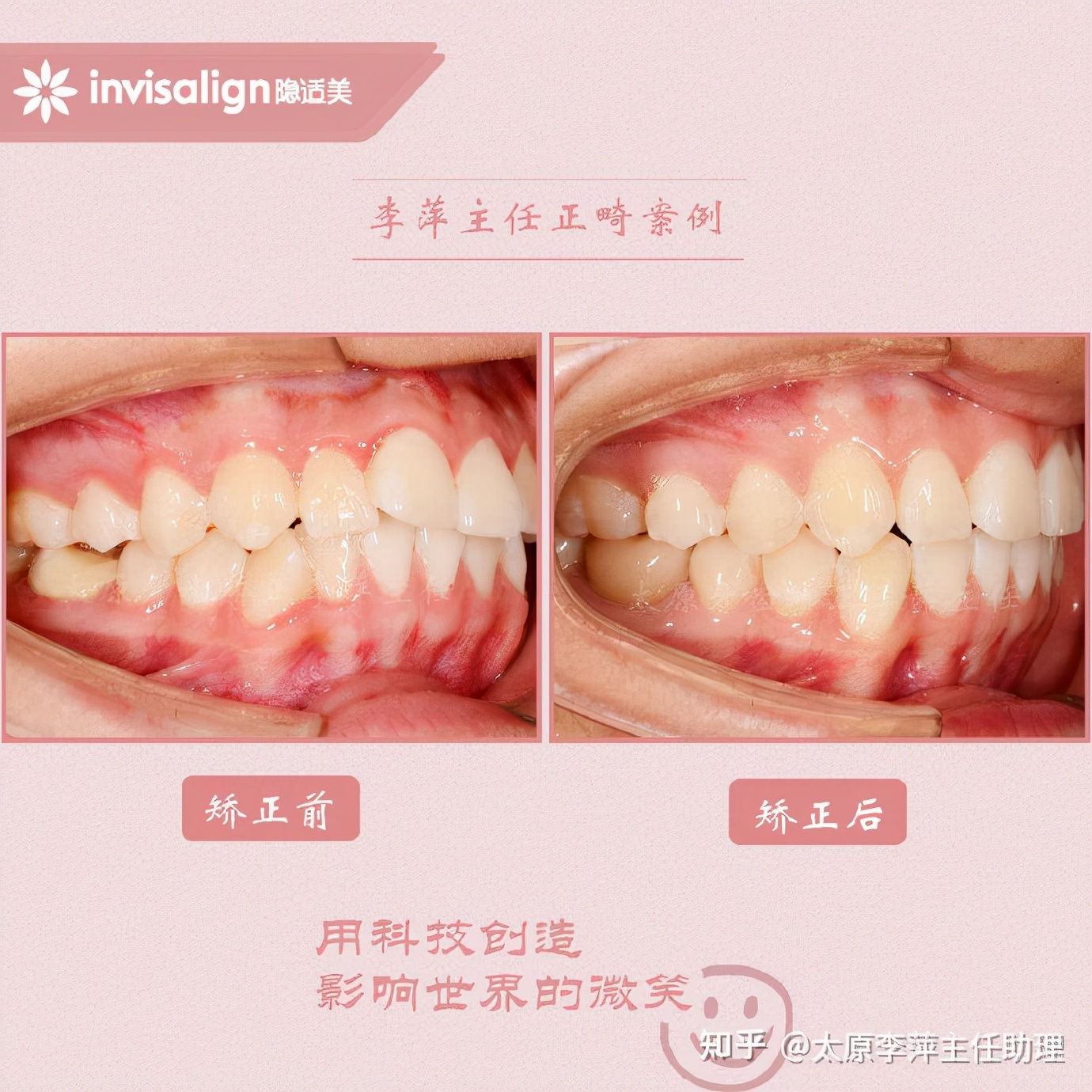 太原牙齿矫正靠谱吗,太原成人隐形牙套牙齿不齐