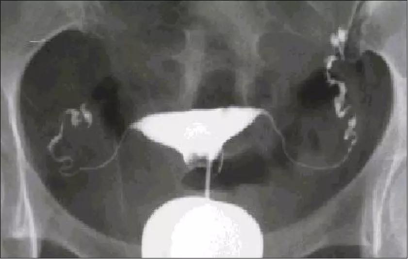 后壁肌壁间子宫肌瘤影响怀孕吗,子宫肌瘤腹腔镜手术后影响怀孕吗