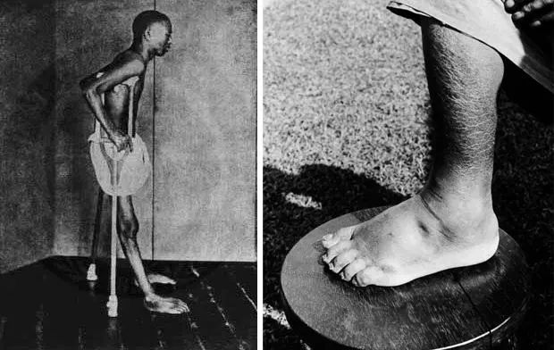 没有传染源怎么得脚气了,脚气病菌是怎么得的