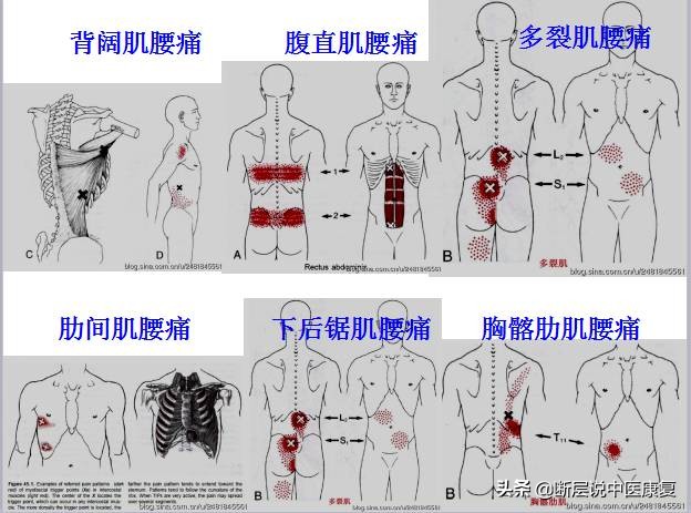 激痛点挂图,激痛点疗法笔记