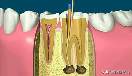 根管治疗后的牙蛀牙怎么办,根管治疗再治蛀牙