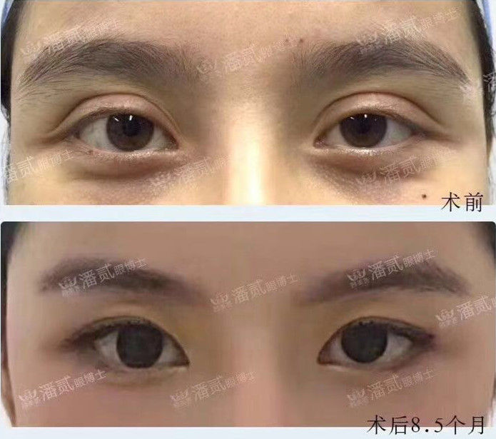 自己的双眼皮太深显老怎么修复,做的双眼皮一笑有皱纹怎么修复