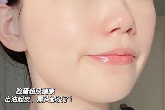 黑头毛孔粗大变细腻,皮肤黑头多毛孔大油脂分泌旺盛