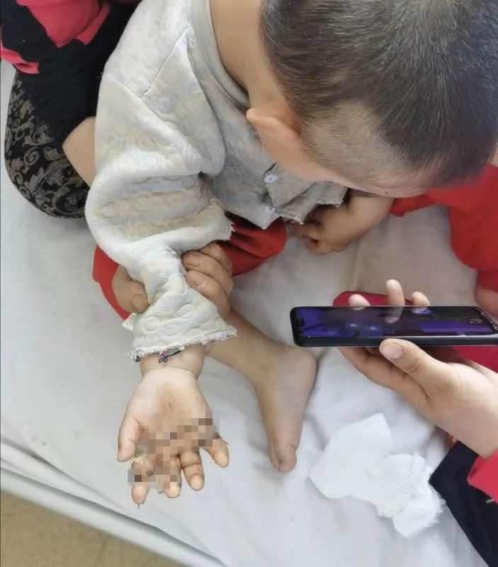 男子不慎断指医生妙手再造手指,男孩手被割伤险断指医生极力救治