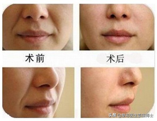 整形医生说医美后遗症,整容拉皮能拉法令纹吗