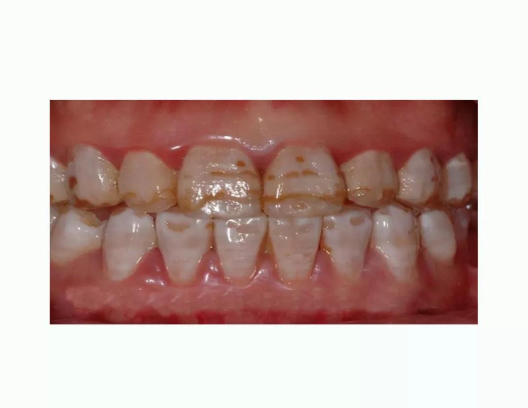 为什么每天刷两次牙还是黄,为什么刷过牙牙还是有点黄