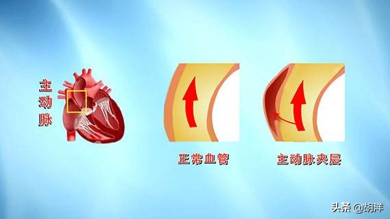 主动脉夹层破裂死亡的原因,主动脉夹层破裂死亡原因