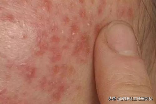 脸上痘印变成癣了怎么回事,痘印长癣