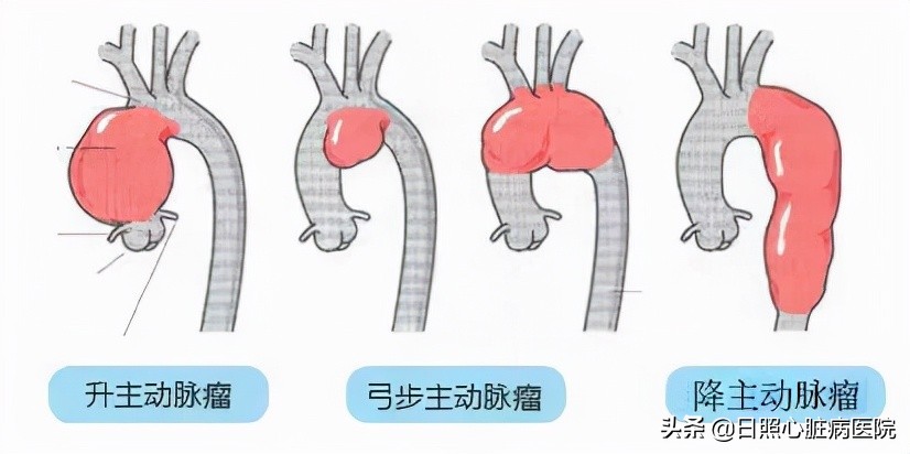 主动脉瘤最典型的症状,主动脉瘤死亡率高的表现