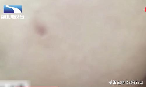 女子打玻尿酸毁容,女子打钢钉致脸发炎视频