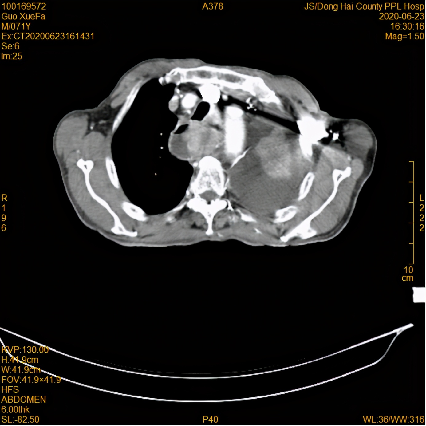 放疗后，82岁高龄食管癌患者情况好转
