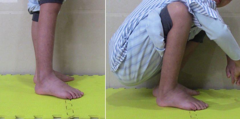 踮脚走路能改善足内翻吗,经常踮脚会伤膝关节吗