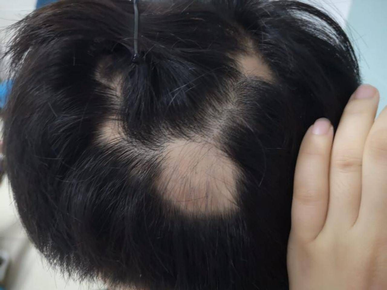 17岁男孩天天熬夜打游戏诱发癫痫,熬夜打游戏小伙子