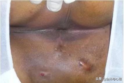 肛门有肿块，可能是这8种疾病！这些知识你要知道