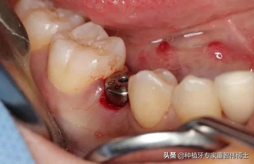 拔牙后即刻种植好还是延期种植好,拔牙后牙槽骨突的修复术视频