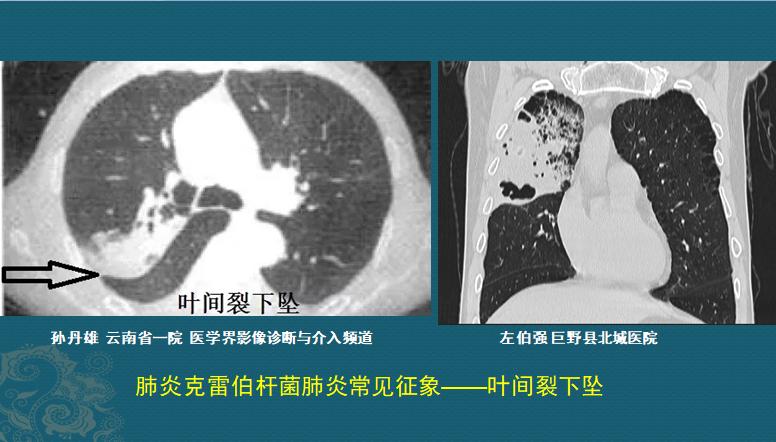 细菌性肺炎吐痰颜色加深,肺炎吐痰粉色需要治疗吗