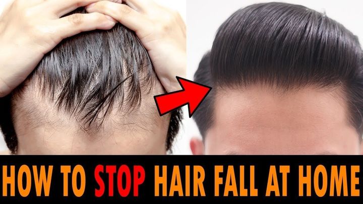 发际线太高了怎么挽救,发际线太高头发稀少怎么挽救