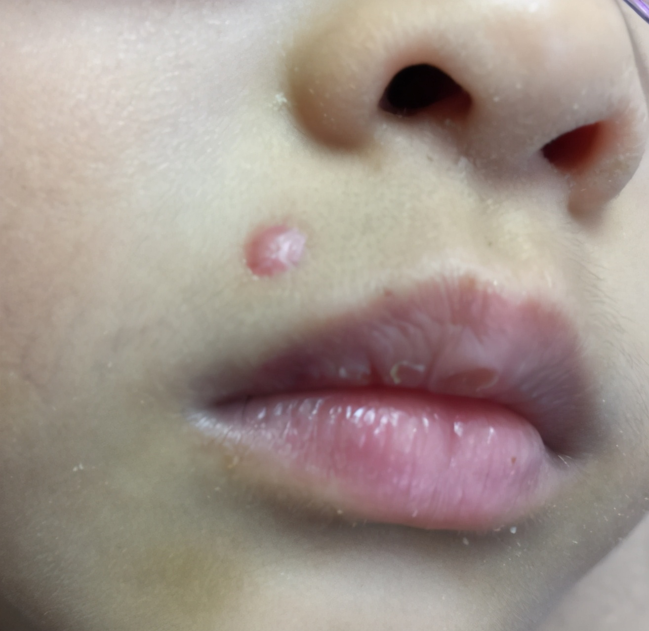 点痣留下了疤痕怎么祛,点痣留下的疤痕怎么消除最有效