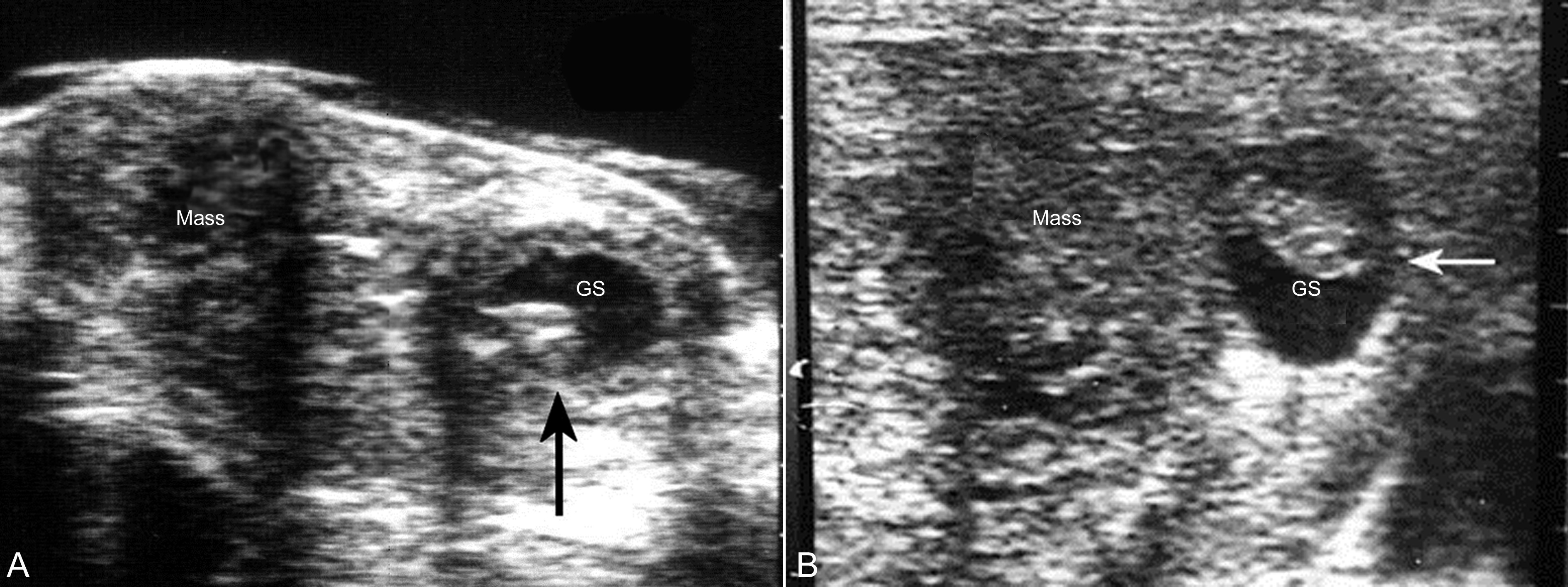 明明白白做超声33-1：妊娠合并子宫肿瘤