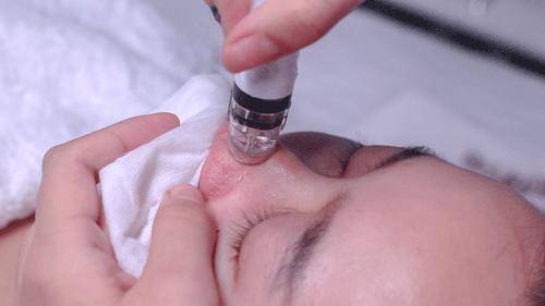 美容院小气泡去黑头有用吗,为什么美容院祛黑头很痛