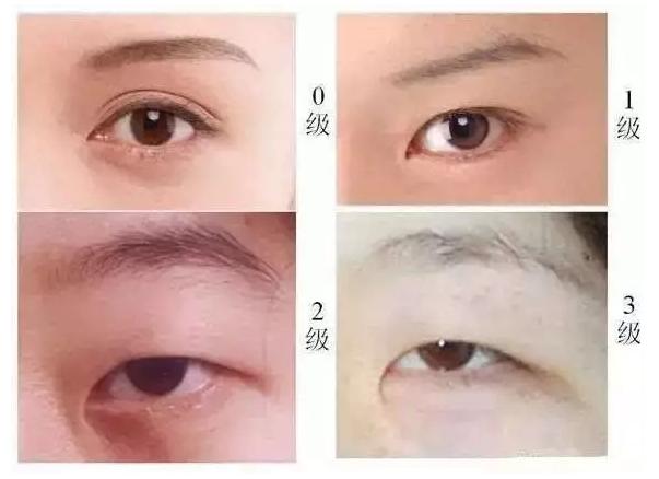 双眼皮效果好怎么形容,双眼皮半个月的效果怎么样