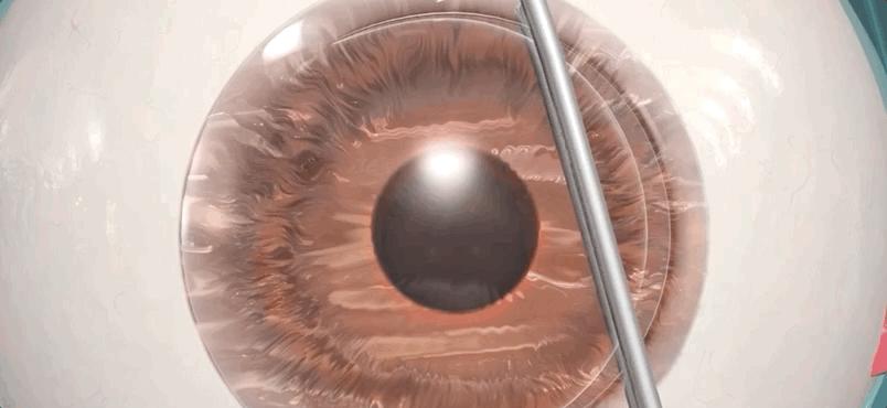 激光治疗近视什么原理,激光矫正是什么原理