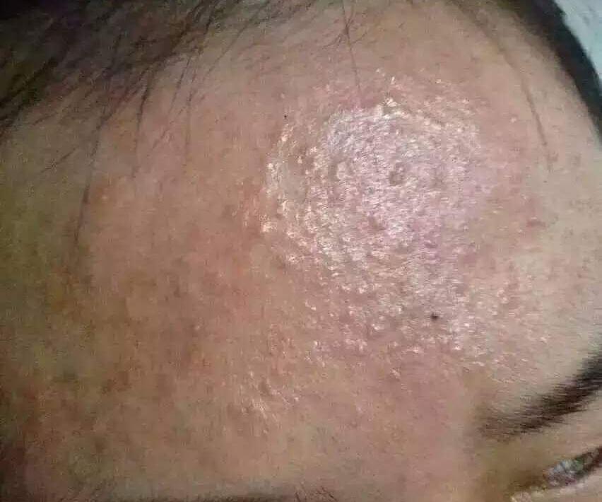 闭合性粉刺到底有多难治？看完本文你就完全清楚了