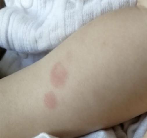 二宝妈妈教你护肤,过敏宝宝的育儿分享