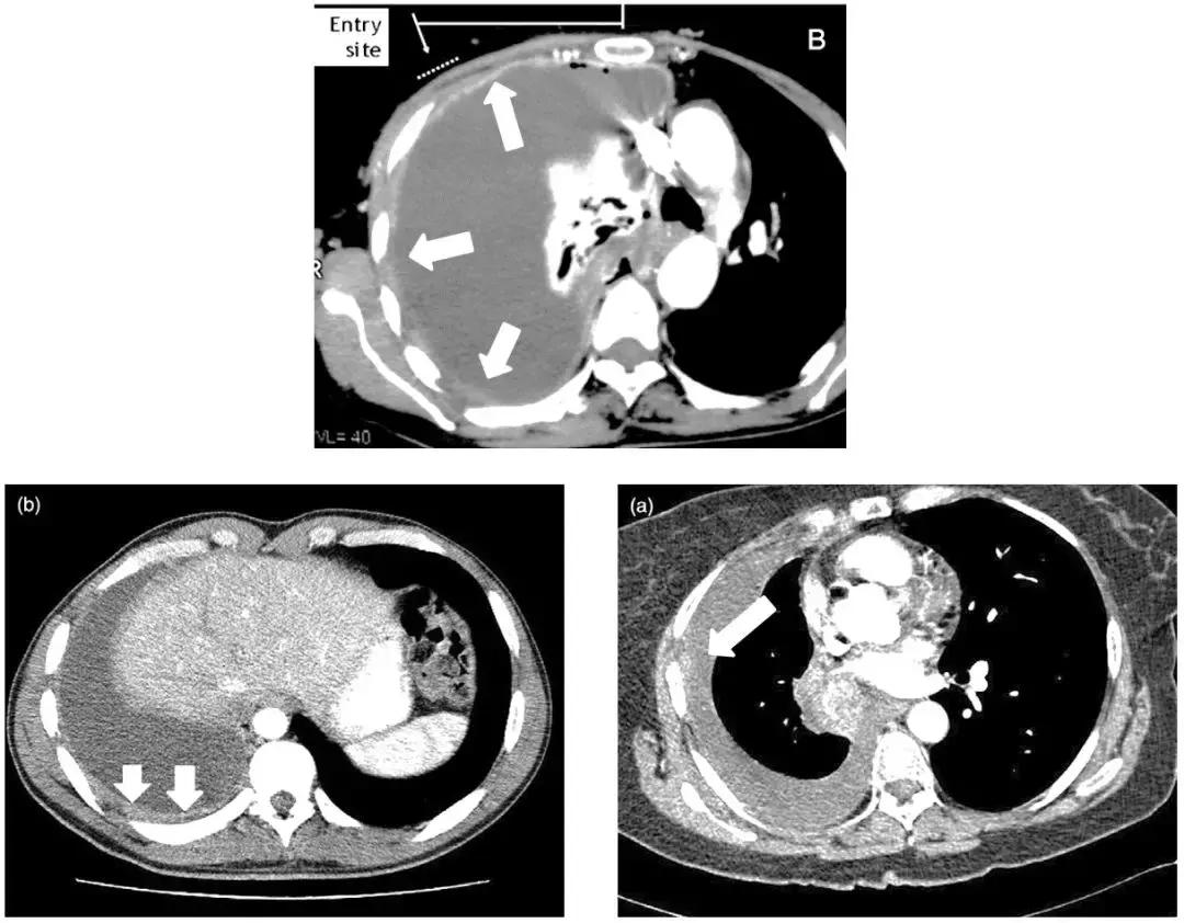 ct引导下穿刺活检诊断的分析,超声引导下穿刺活检什么样子的呢
