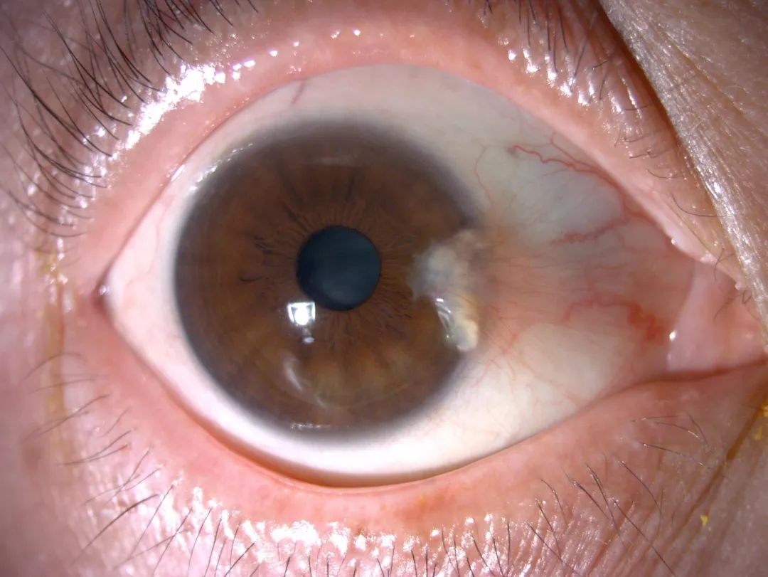 眼睛长出翅膀,眼睛长翅膀