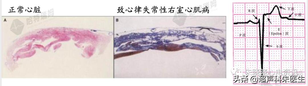 t波倒置9个真相图解,t波倒置判断口诀
