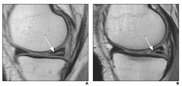 半月板损伤一度最好的康复方法,半月板损伤怎样保守治疗吃什么药