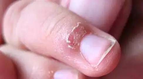 红霉素软膏多少钱有什么作用,几块钱的红霉素软膏淡斑