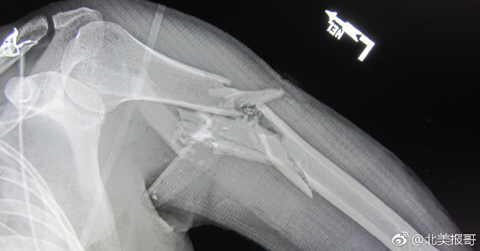 人体一旦被子弹击中后会怎样,被麻醉弹击中会怎样