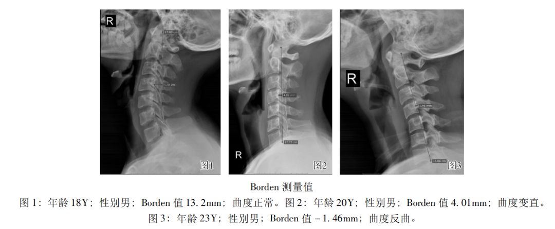 低头玩手机如何缓解颈椎,你还在侧躺玩手机吗
