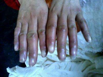 冻伤是不可逆的么,低温冻伤最严重的是什么