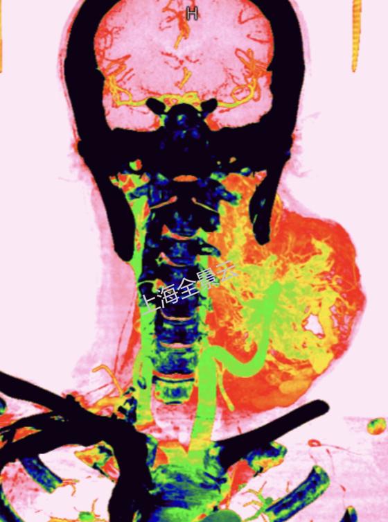 颈部肿块为什么有80%是肿瘤,颈部肿块1年没有变化