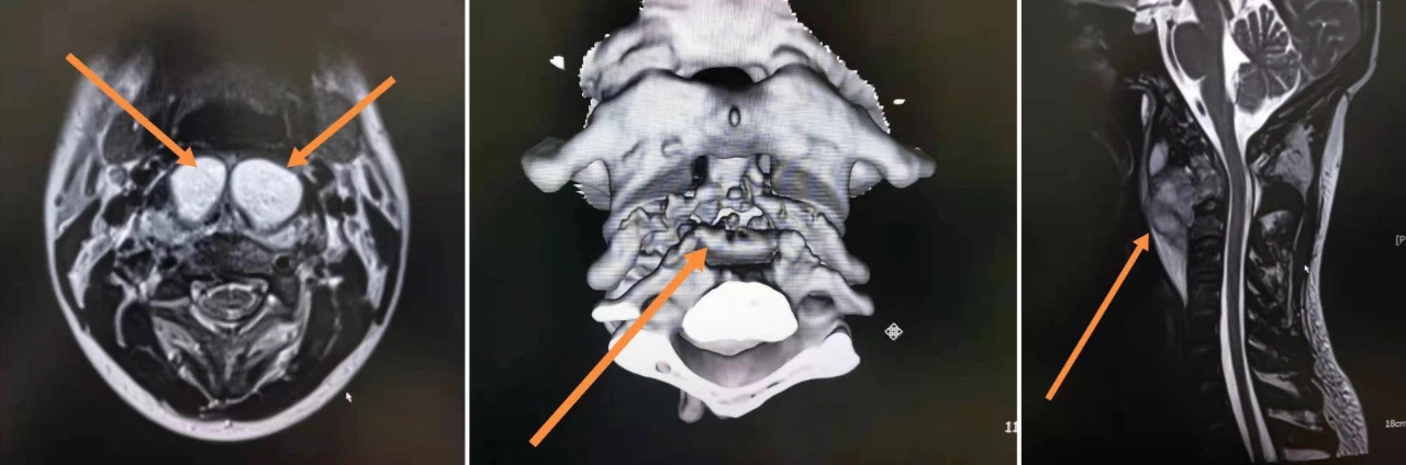 突然半边头和脸麻木能治愈吗,半边头麻木站起来不稳